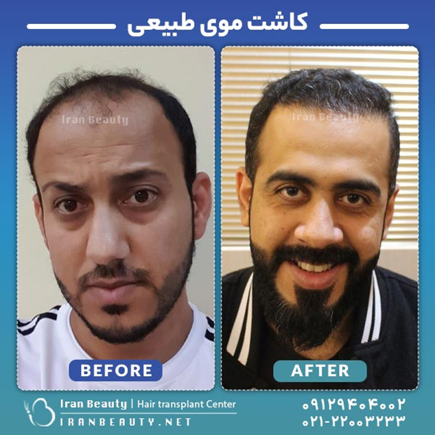 کاشت مو به روش DHI چیست چگونه انجام میشود؟