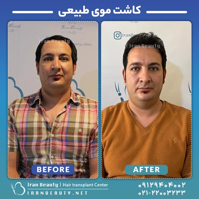 کاشت مو به روش DHI چیست چگونه انجام میشود؟