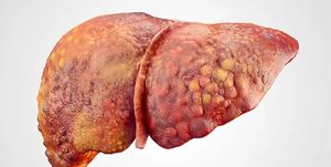 درمان کبد چرب بدون دارو