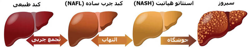 آیا کبد چرب قابلدرمان است؟