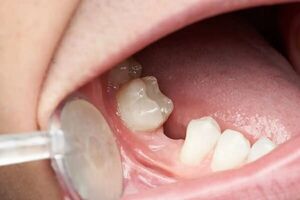 راه‌هایی برای کاهش پوسیدگی دندان