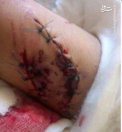 حمله سگهای ولگرد به یک دختر دانشآموز+ عکس