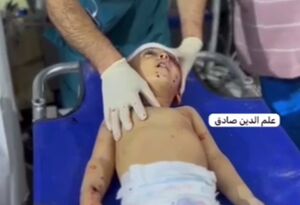 کودک مجروح فلسطینی در بمباران شب گذشته رفح