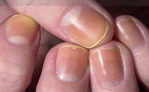 به ناخنهایتان نگاه کنید تا بفهمید چه بیماری دارید