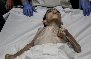 شهادت یک کودک دیگر فلسطینی بر اثر سوء تغذیه
