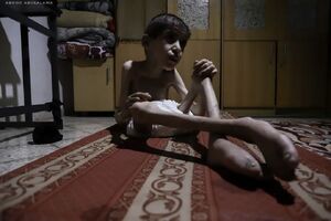 عکس/ وضعیت کودک ۱۵ ساله فلسطینی بر اثر سوءتغذیه!