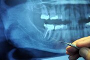۶ علت درد بعد از عصب کشی دندان
