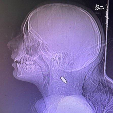 روایت تکاندهنده پزشکان داوطلب از وضعیت کودکان غزه +تصاویر