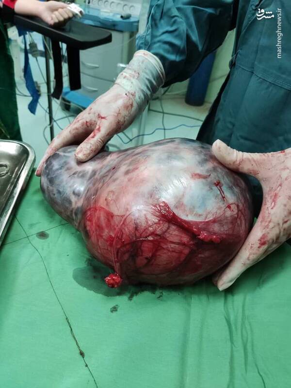 خروج توده شکمی ۲۰ کیلویی از بدن یک بیمار+ عکس