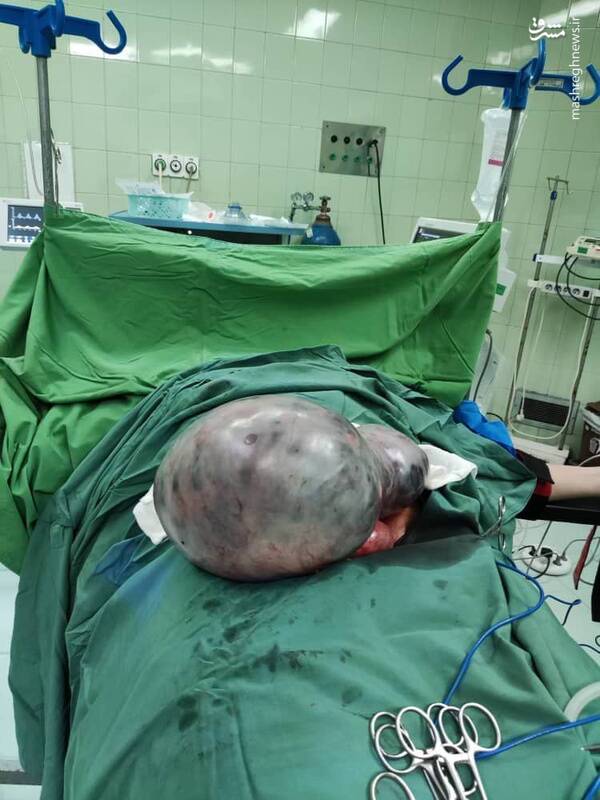 خروج توده شکمی ۲۰ کیلویی از بدن یک بیمار+ عکس