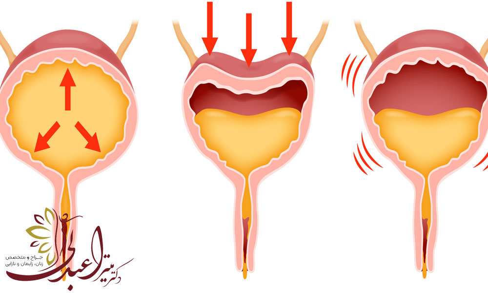 علت و درمان بی اختیاری ادرار