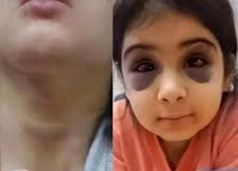 ضرب و شتم هولناک دختربچه ۹ ساله توسط نامادری+ عکس | ارجاع پرونده کودکآزاری به دادگستری