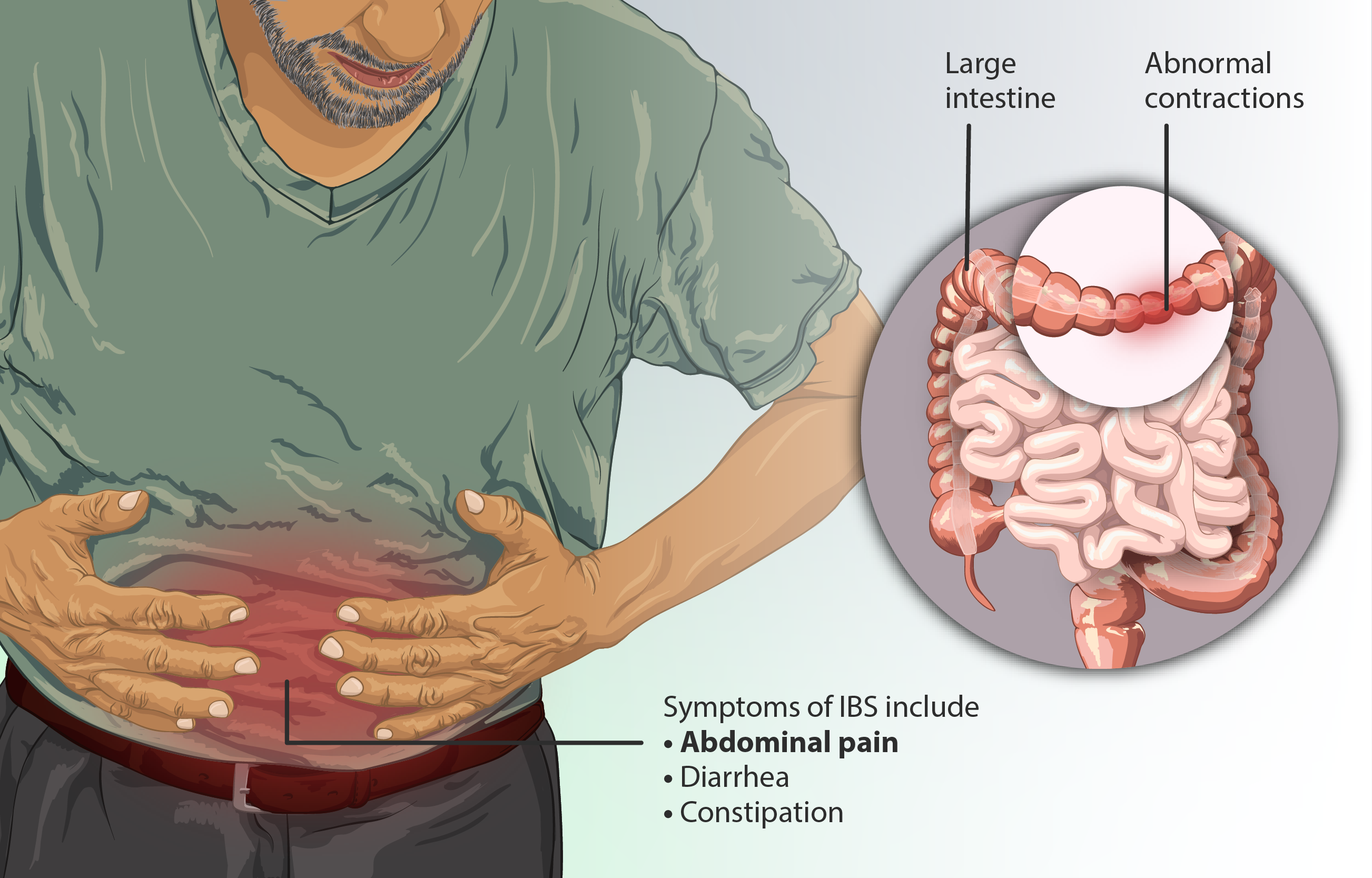 سندرم روده تحریک‌پذیر (IBS) چیست و چگونه آن را کنترل کنیم؟