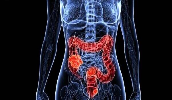 کدام افراد در معرض خطر سرطان روده هستند؟