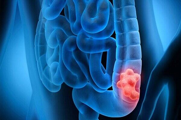 کدام افراد در معرض خطر سرطان روده هستند؟