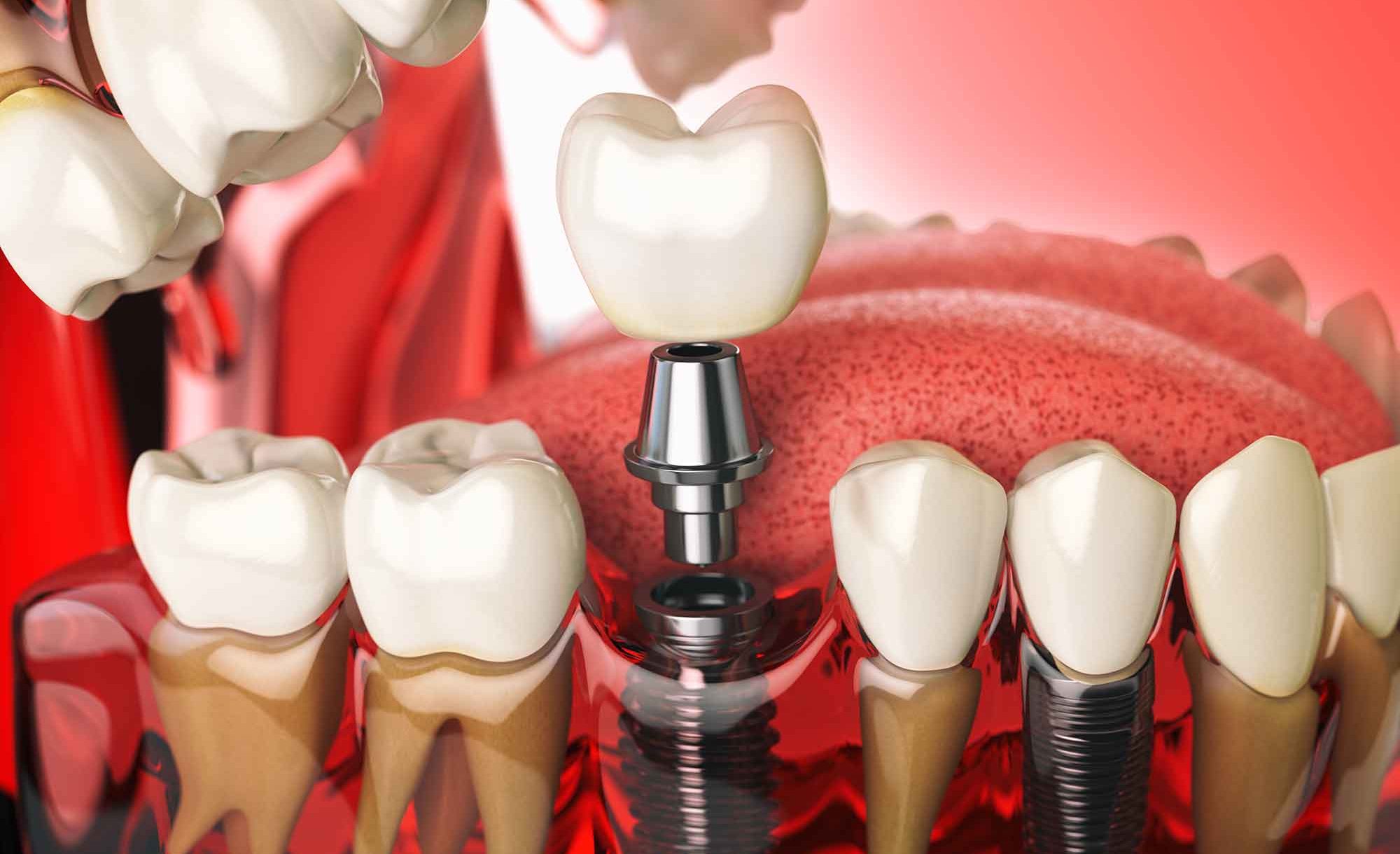 آیا کاشت دندان سرطان زاست؟