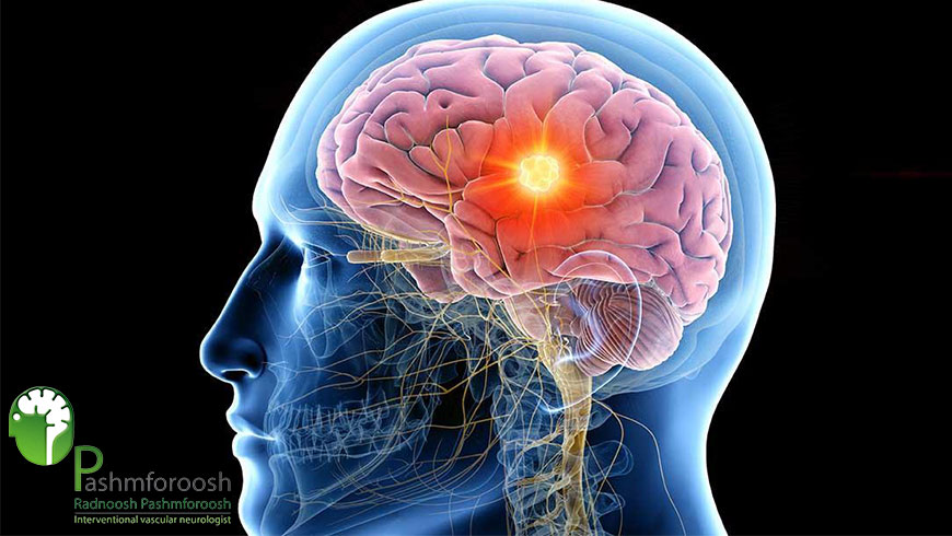 بیماری صرع چیست و چگونه درمان می شود؟