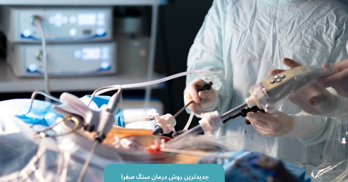 جدیدترین روش درمان سنگ کیسه صفرا