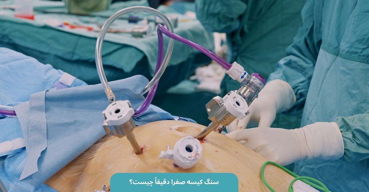 جدیدترین روش درمان سنگ کیسه صفرا