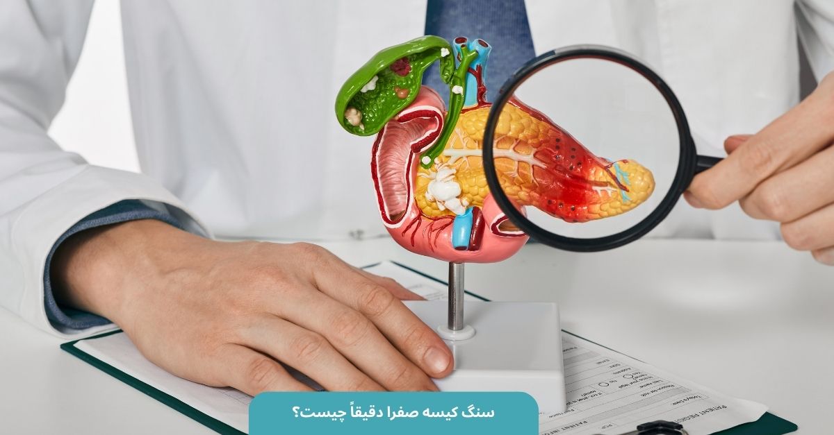 جدیدترین روش درمان سنگ کیسه صفرا