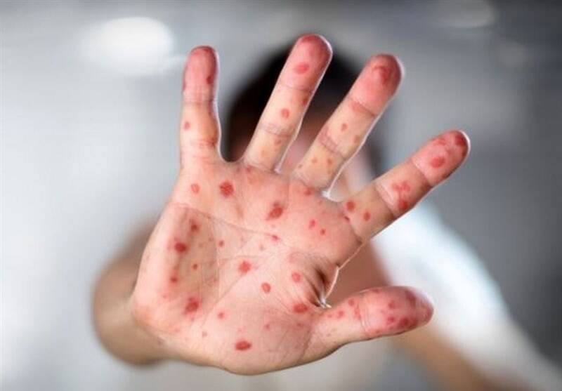 سرخك،كشور،واكسن،مبتلا،درصد،شيوع،پوشش،واكسيناسيون