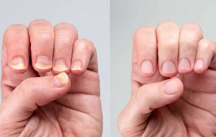 علت تغییر رنگ ناخن‌ها چیست؟