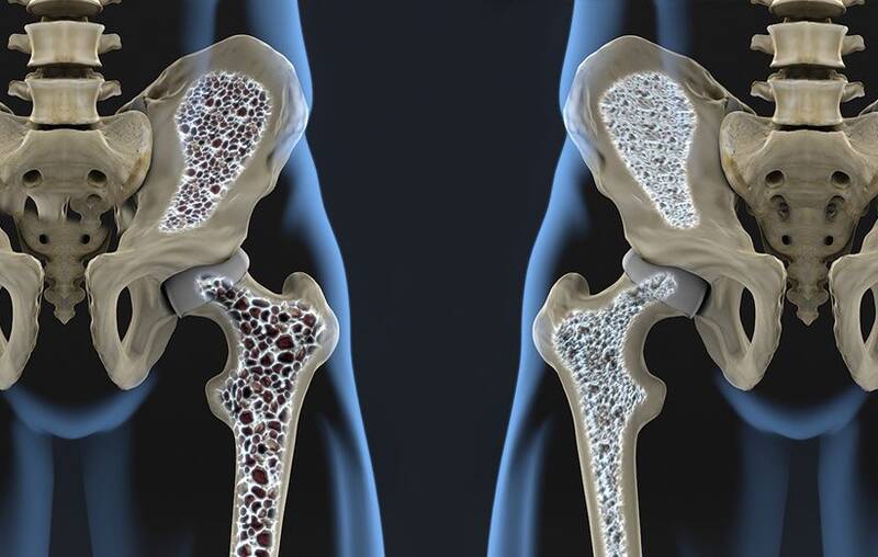 مهمترین زنگ خطرهای پوکی استخوان (دلایل، علائم و راههای پیشگیری) • دیجیکالا مگ