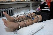 جراحی افزایش قد؛ معجزه یا شکنجه مدرن؟