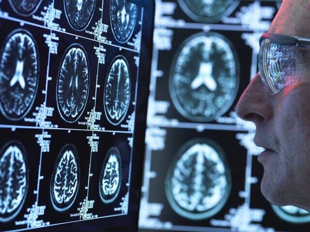 عامل اصلی ابتلا به آلزایمر کشف شد