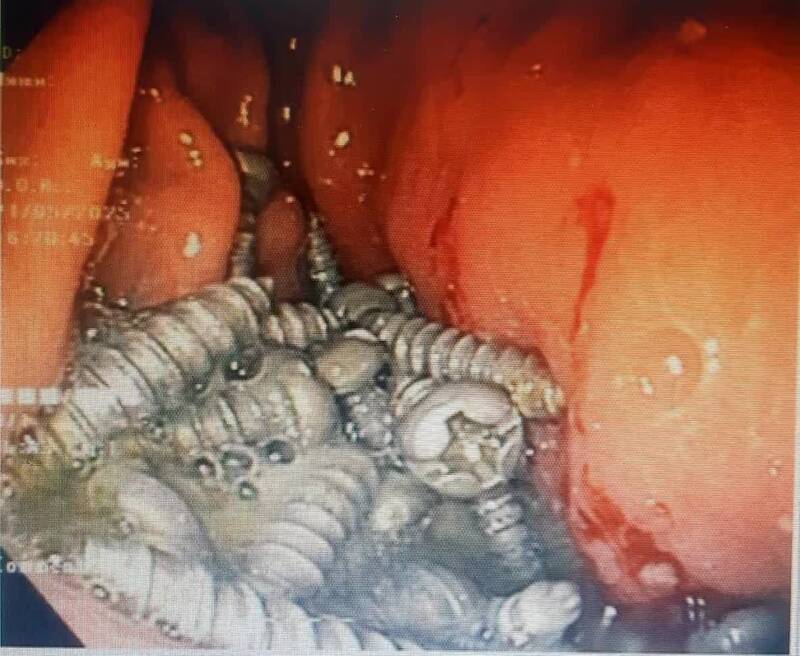 بيمار،پيچ،گوارش،معده،فلزي
