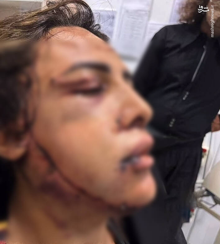 شیوع عوارض عفونی ناشی لیفت چربی به صورت/ وقتی زنجیرهای زیبایی و سادگی در آرایشگاهها/ صورت بالشتیها بخوانند