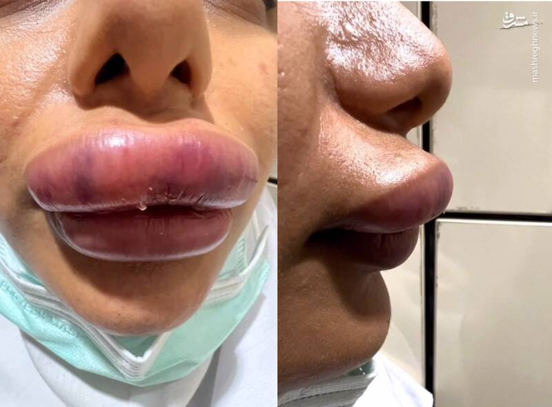 شیوع عوارض عفونی ناشی لیفت چربی به صورت/ وقتی زنجیرهای زیبایی و سادگی در آرایشگاهها/ صورت بالشتیها بخوانند