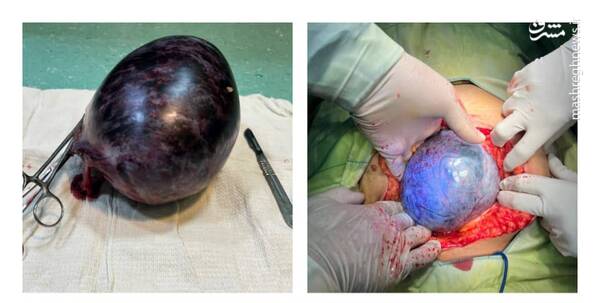 خروج توده ۴ کیلویی از شکم بیمار ۷۵ ساله + عکس