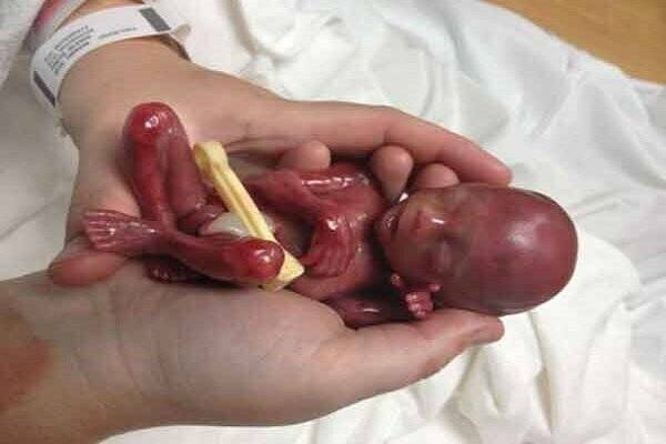 رد پای دخانیات در اتاق زایمان!