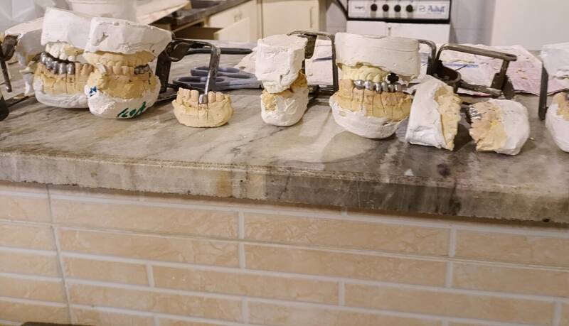 پشت پرده دندانسازی ارزان؛ از مواد درجه چندم تا مشتریان ناآگاه/ دندانسازان زیرزمینی؛ صنف پرسود در سایه قانون!