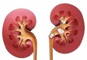 علائم سنگ کلیه؛ چه افرادی بیشتر در معرض ابتلا هستند؟