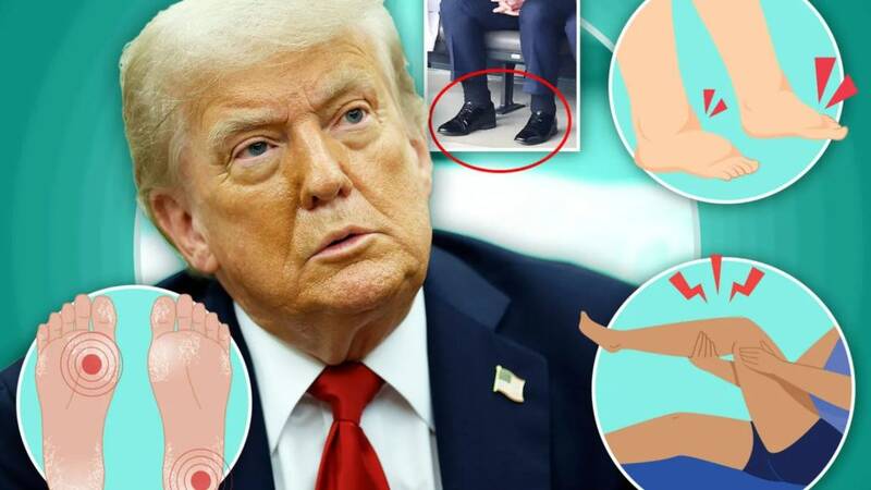 بررسی عارضهی «نارسایی مزمن وریدی» رئیس جمهور آمریکا/ آیا بیماری ترامپ مرگبار است؟ +عکس