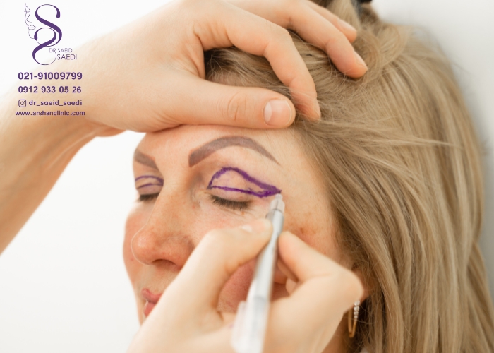 نتیجه عمل بلفاروپلاستی کی مشخص می شود