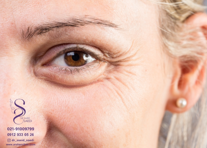 علت کوچک شدن چشم بعد از عمل بلفاروپلاستی
