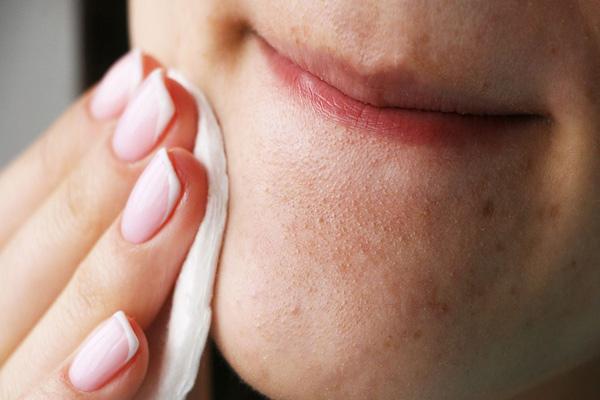 بهترین روش های درمان جوش صورت با راهکارهای اثربخش