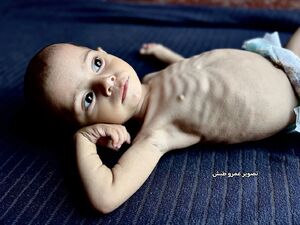 سوء تغذیه شدید شیرخواره فلسطینی