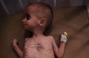 فیلم/ حال و روز یک کودک فلسطینی بر اثر سوءتغذیه در خان یونس