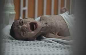کودک چهارماهه غزه‌ای در معرض سوءتغذیه شدید