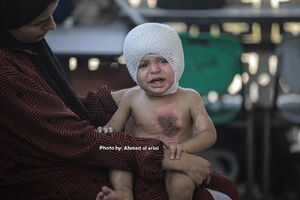 اثر آتش کینه صهیونیست‌ها بر روی بدن کودک فلسطینی