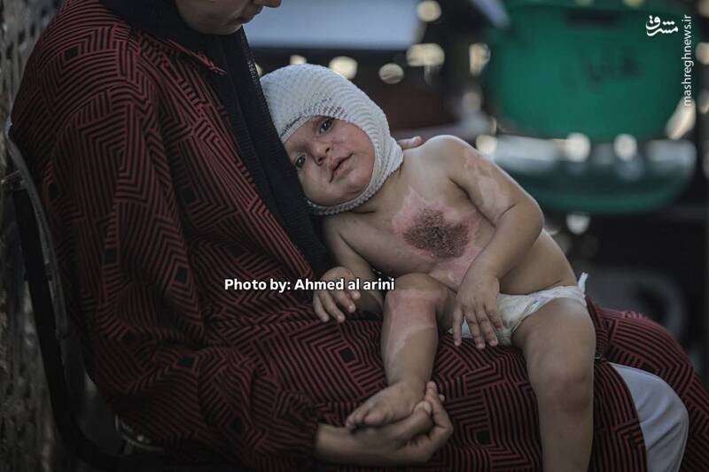 عکس/ اثر آتش کینه صهیونیستها بر روی بدن کودک فلسطینی