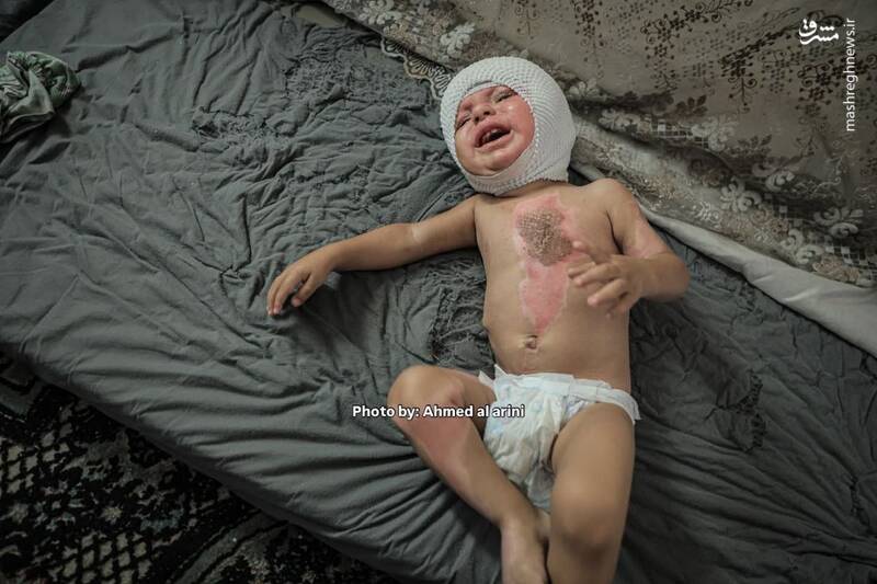 عکس/ اثر آتش کینه صهیونیستها بر روی بدن کودک فلسطینی