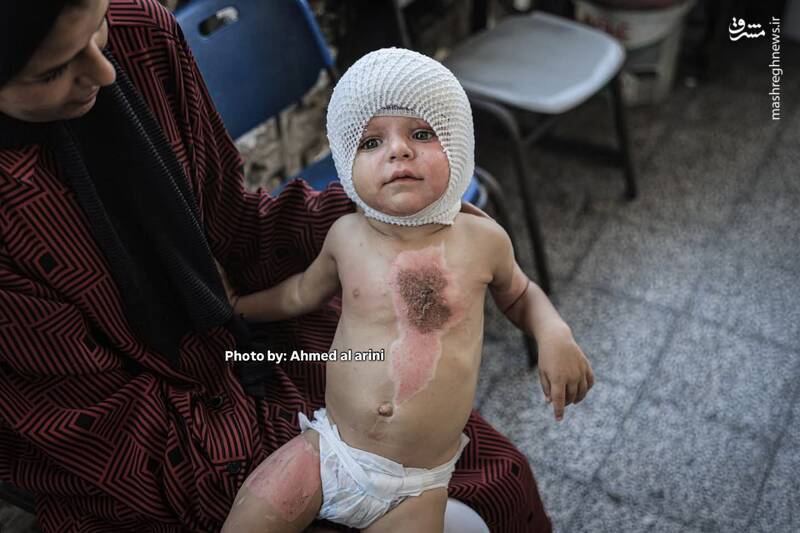 عکس/ اثر آتش کینه صهیونیستها بر روی بدن کودک فلسطینی