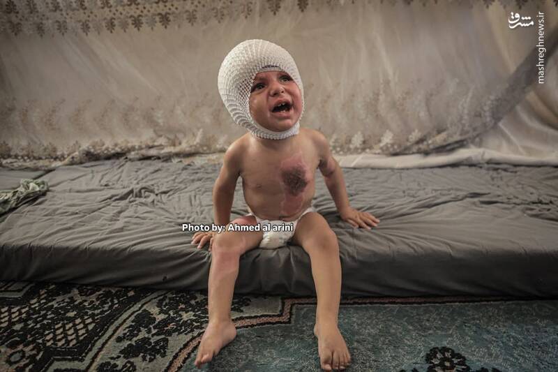 عکس/ اثر آتش کینه صهیونیستها بر روی بدن کودک فلسطینی