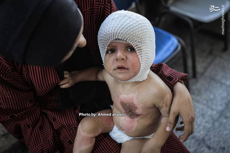 عکس/ اثر آتش کینه صهیونیستها بر روی بدن کودک فلسطینی
