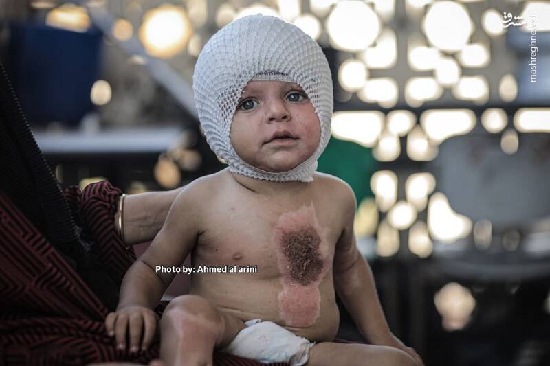 عکس/ اثر آتش کینه صهیونیستها بر روی بدن کودک فلسطینی